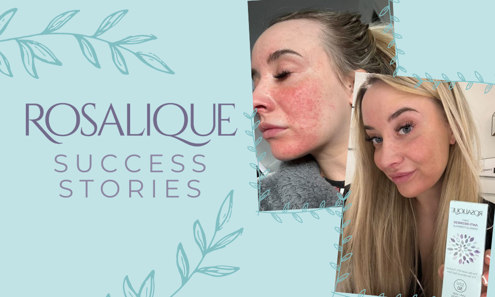 Rosacea Success Stories