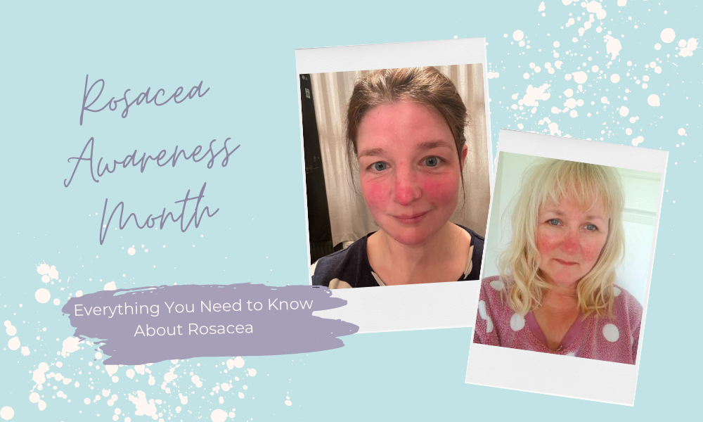Everything You Need to Know About Rosacea