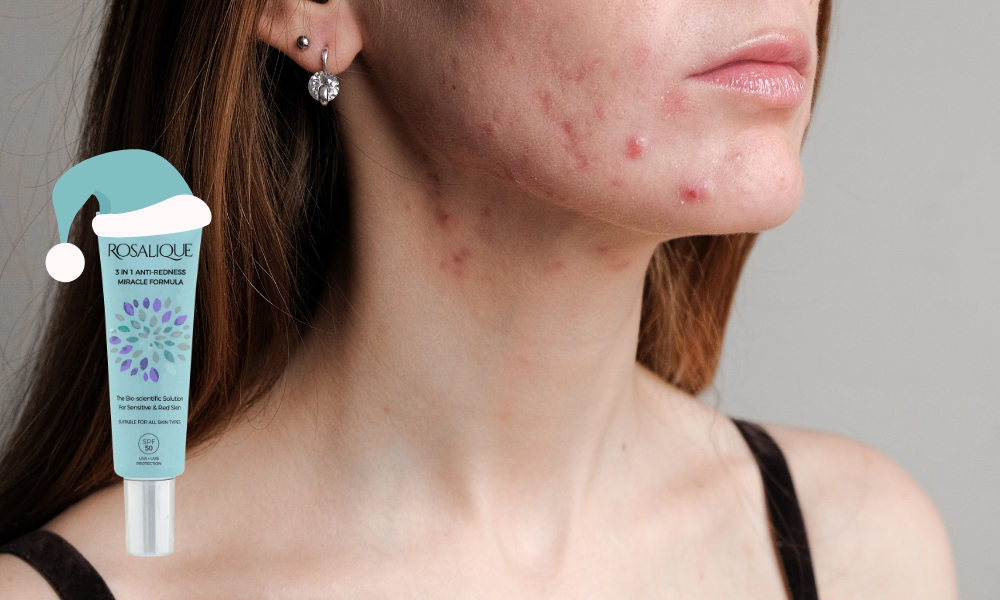 How to Look After Your Congested Skin Through The Holidays