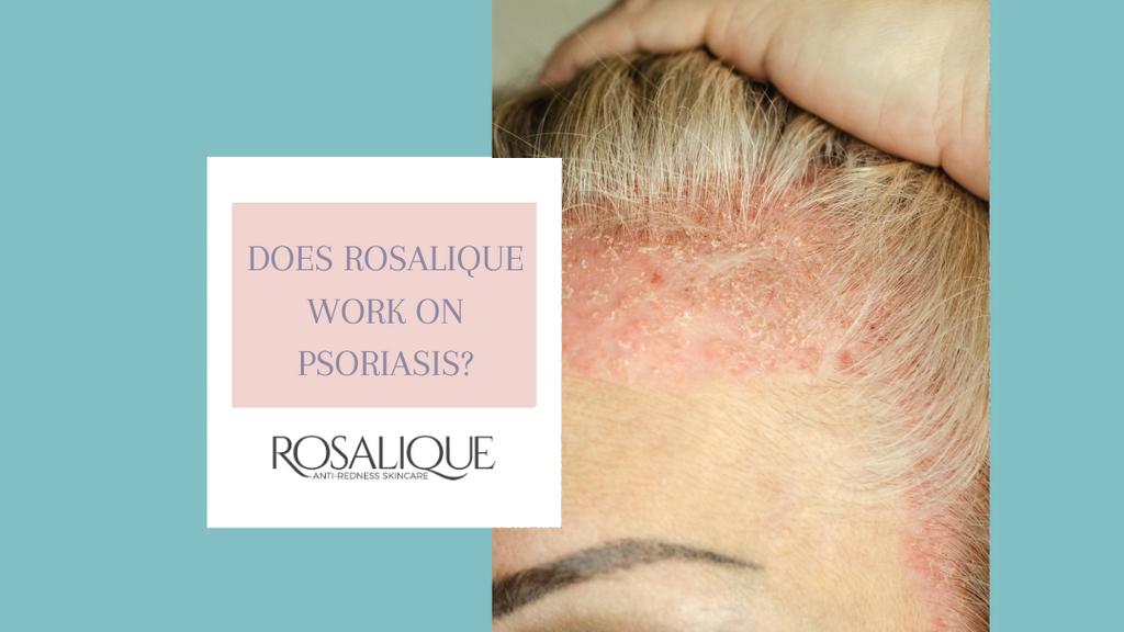 Does Rosalique work for psoriasis?