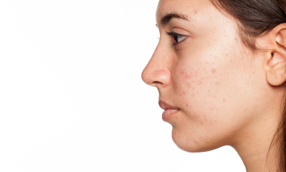 Let's Discuss - What Is Acne?