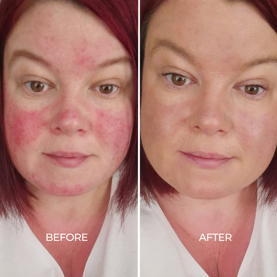 Rosacea Care Kit